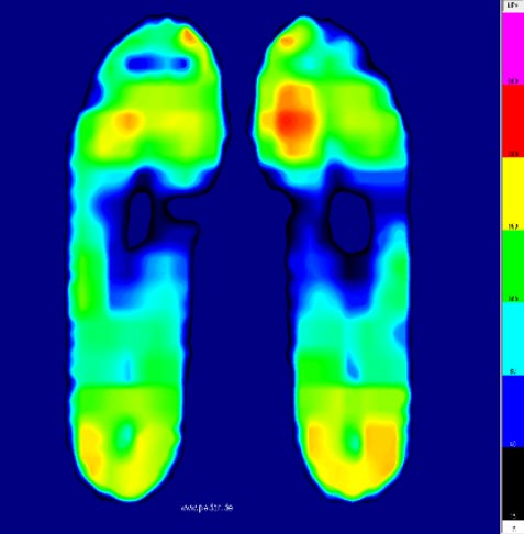 SIDAS条件の足圧分布