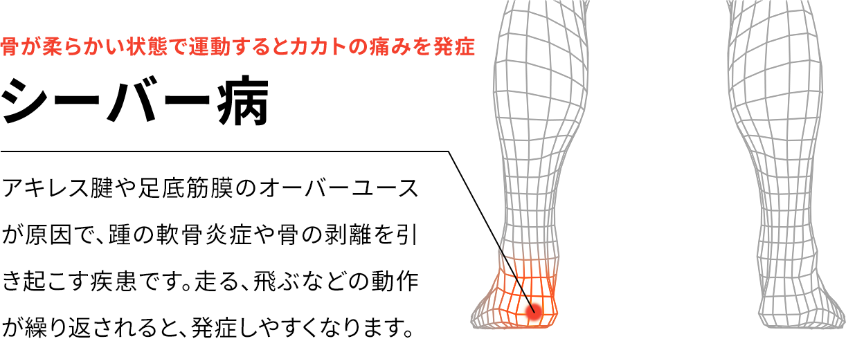 骨が柔らかい状態で運動するとカカトの痛みを発症 シーバー病 アキレス腱や足底筋膜の硬さが原因で、踵の軟骨炎症や骨の剥離を引き起こす疾患です。走る、飛ぶなどの動作が繰り返されると、発症しやすくなります。