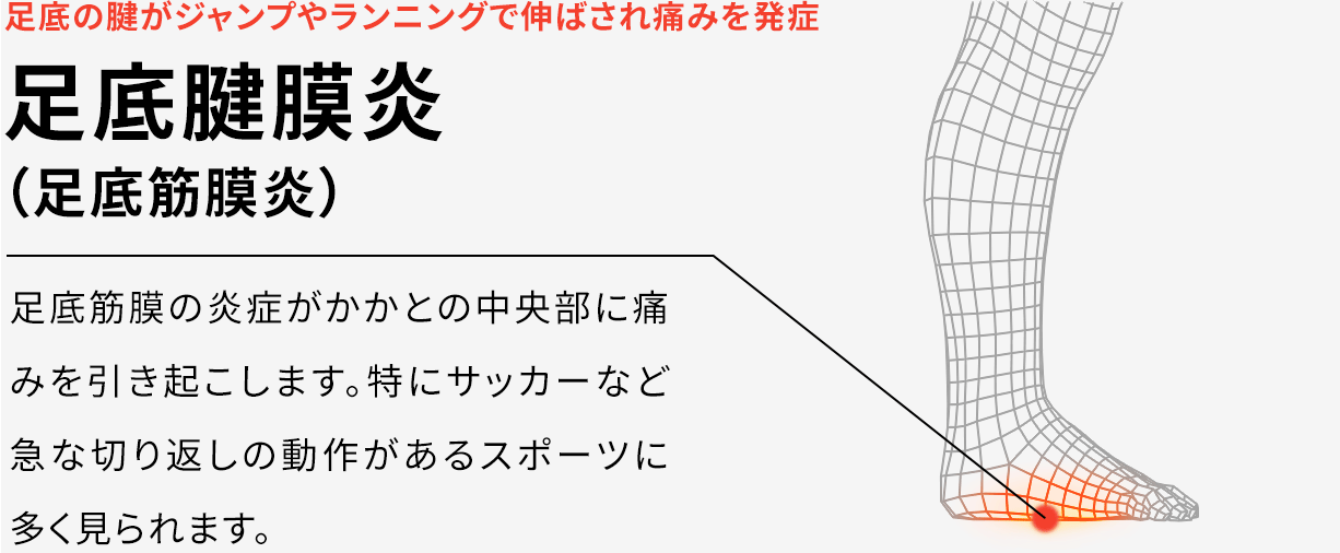 足底の腱がジャンプやランニングで伸ばされ痛みを発症 足底腱膜炎（足底筋膜炎）足底筋膜の炎症がかかとの中央部に痛みを引き起こします。特にサッカーなど急な切り返しの動作があるスポーツに多く見られます。