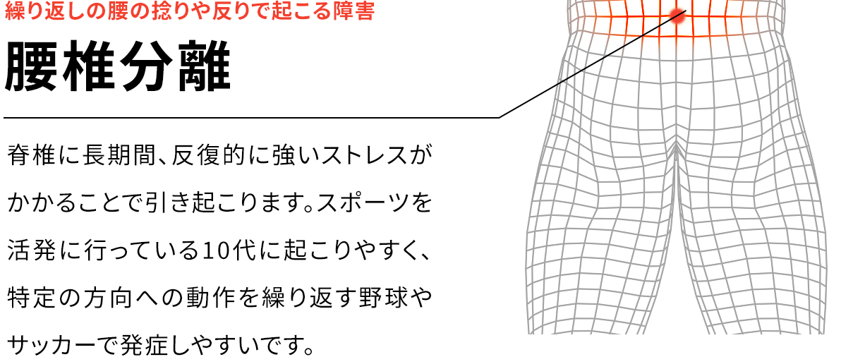 繰り返しの腰の捻りや反りで起こる障害 腰椎分離 脊椎に長期間、反復的に強いストレスがかかることで引き起こります。スポーツを活発に行っている10代に起こりやすく、特定の方向への動作を繰り返す野球やサッカーで発症しやすいです。