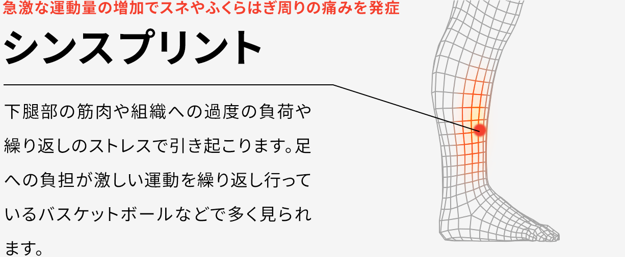 急激な運動量の増加でスネやふくらはぎ周りの痛みを発症 シンスプリント 下腿部の筋肉や組織への過度の負荷や繰り返しのストレスで引き起こります。足への負担が激しい運動を繰り返し行っているバスケットボールなどで多く見られます。